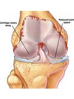 Arthritis Cause
