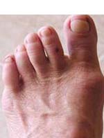 Arthritis Foot Pain