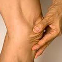 Arthritis Joint Pain