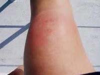 Arthritic Knee Pain