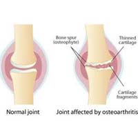 The Difference Between Glucosamine and Chondroitin
