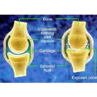 Glucosamine Sulphate | arthritis pain