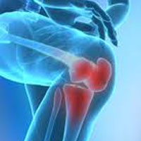 Glucosamine Hyaluronic Acid
