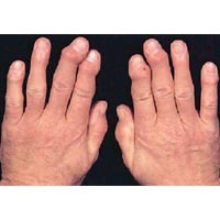 Joint Arthritis
