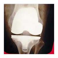 Joint Pain Cause