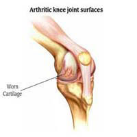 Knee Osteoarthritis