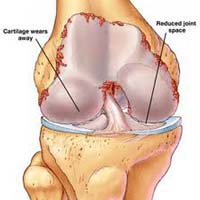 Rheumatoid Arthritis Treatment