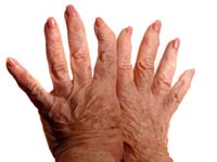 About Rheumatoid Arthritis