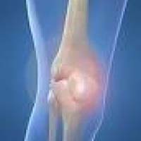 Treating Rheumatoid Arthritis
