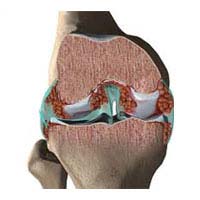 Treatment of Arthritis