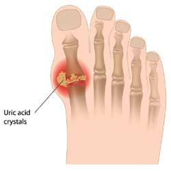 Below is the list of effective Gout Arthritis Treatments