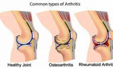 What are all the Different Types of Arthritis?