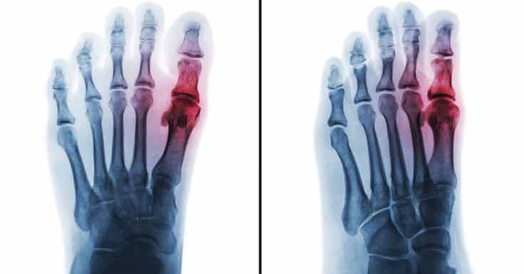 Appearance of Arthritis