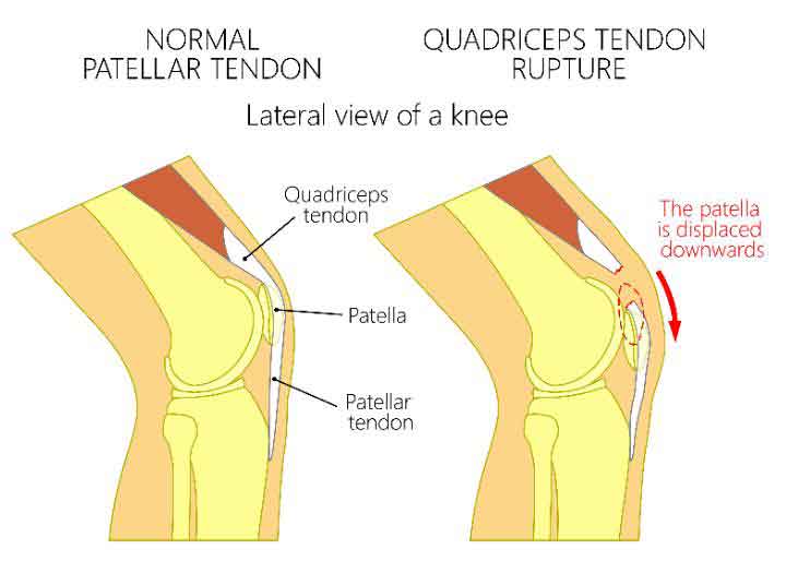 Knee Pain Due To Tendonitis
