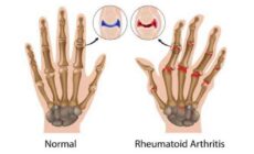 Finger Joint Pain – Symptoms, Causes, Treatments & More