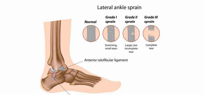 Severe Ankle Joint Pain