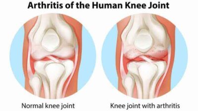 The #22 Different Types of Joint Pain You Must Know