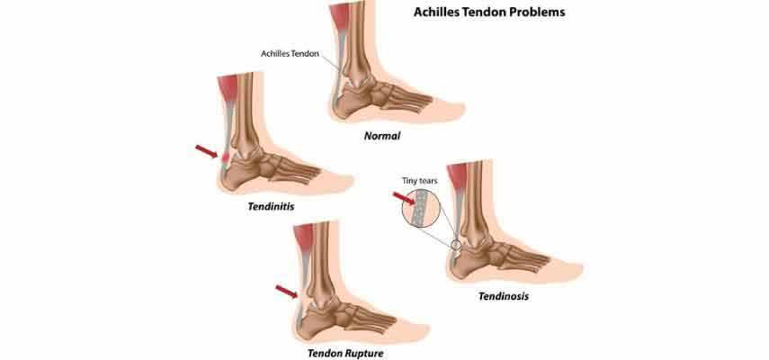 Home Remedies For Tendonitis