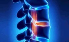 All You Need To Know About Facet Joint Pain