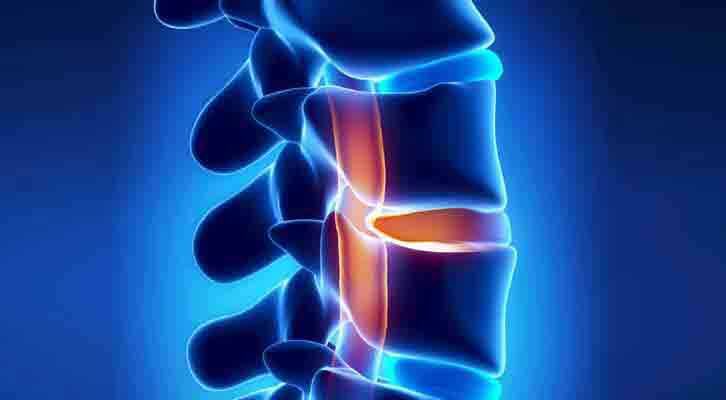 All You Need To Know About Facet Joint Pain