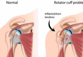Rotator Cuff Tears