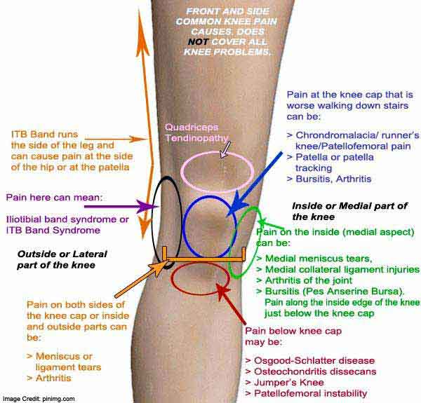 Arthritis Muscle Pain Know The Causes Of Knee Muscle Pain