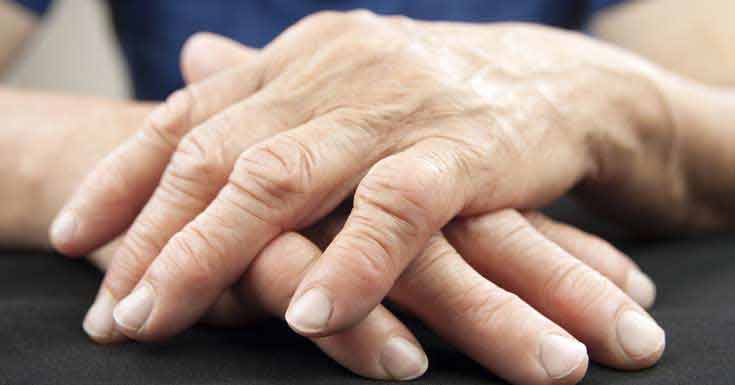 Rheumatoid Arthritis