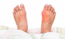 Gout (Gouty Arthritis): Symptoms, Treatment, Causes, & More