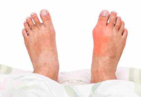Gouty Arthritis