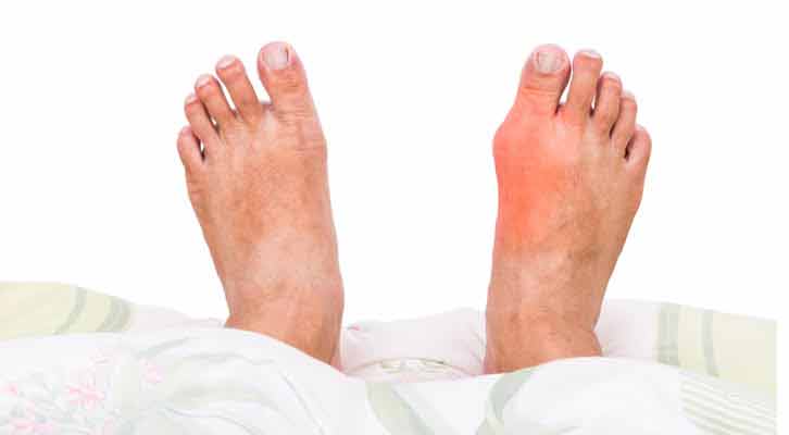 Gouty Arthritis: Know the Symptoms and Treatments