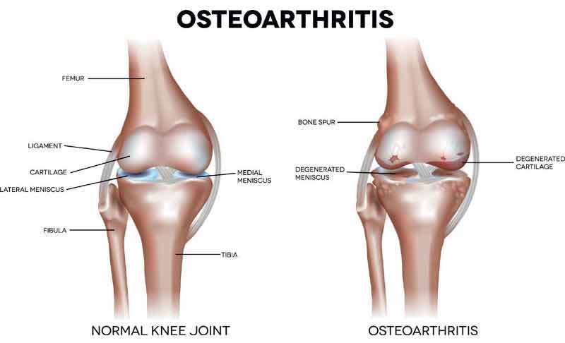 Osteoarthritis Detail