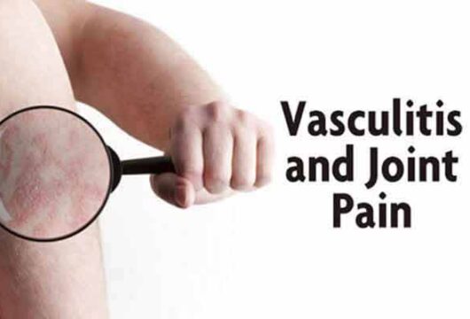 What are the Causes of Vasculitis?