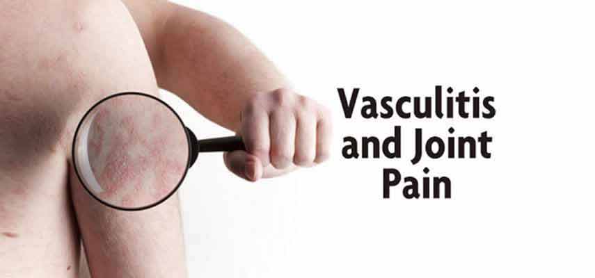 Causes of Vasculitis