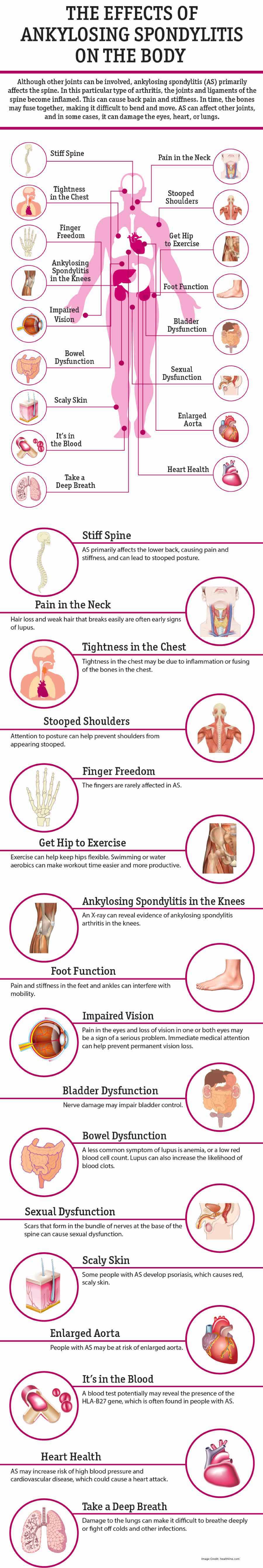 Ankylosing Spondylitis Info
