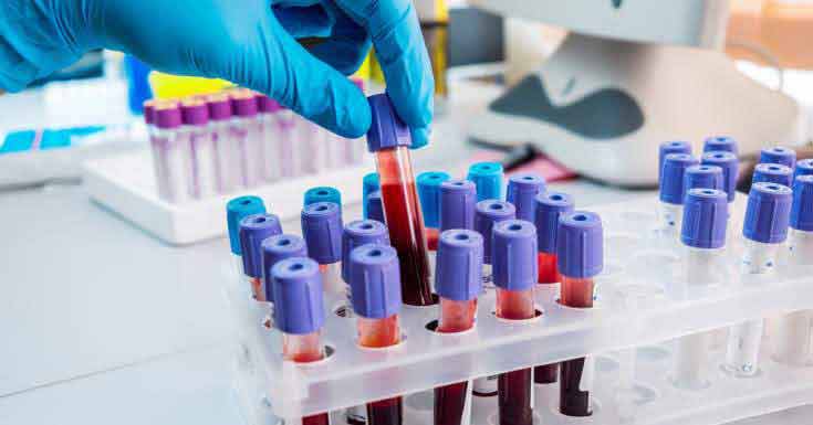 Diagnosis Of Ankylosing Spondylitis