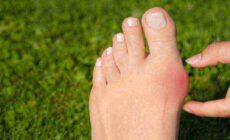 Bunions Explained – How To Get Rid of Bunions on Your Feet