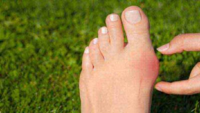 Bunions Explained – How To Get Rid of Bunions on Your Feet