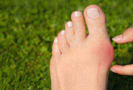 Bunions Explained – How To Get Rid of Bunions on Your Feet