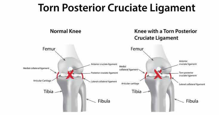 Posterior Cruciate Ligament  Injuries