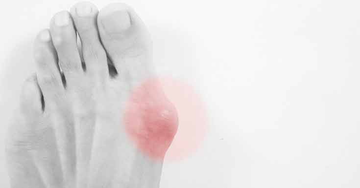 Symptoms of Bunions