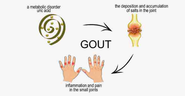 Gout