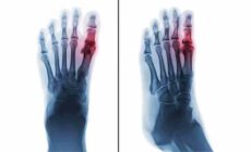 Inflammatory Arthritis – Types, Symptoms, Causes & Treatments