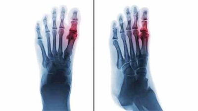 Inflammatory Arthritis – Types, Symptoms, Causes & Treatments