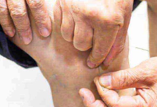 Ancient Art of Acupuncture As A Remedy For Knee Arthritis