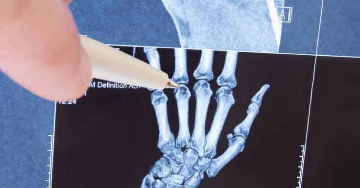 Juvenile Arthritis Diagnosed