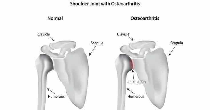 Osteoarthritis