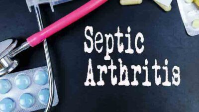 Septic Arthritis – Read the Symptoms, Causes, Risks, and Treatment