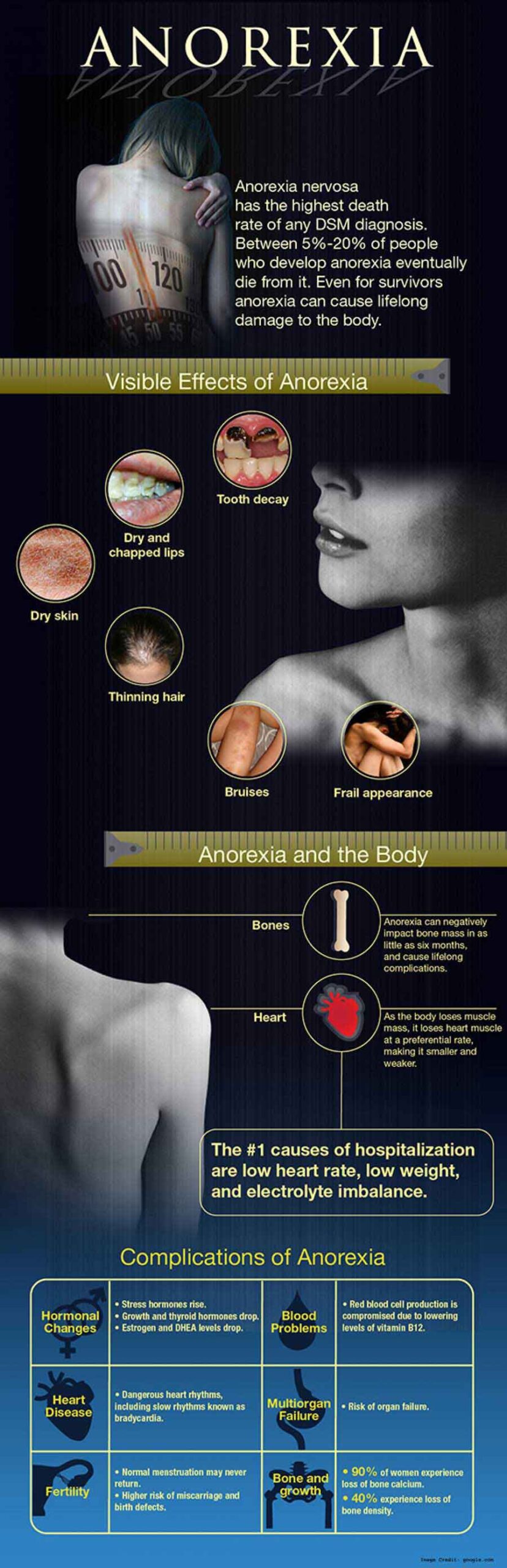 Anorexia Info