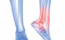 How Do You Treat Foot Pain?